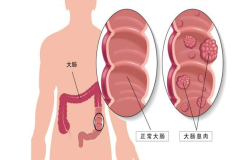 腸息肉會(huì)癌變嗎？腸鏡檢查出腸息肉千萬(wàn)別大意！