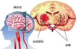 原來高血壓和腦出血有這樣的關系......高血壓別不當回事，警惕變成腦出血！