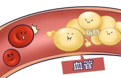 收好這份“血脂達標數據”，盡量不給血管添堵